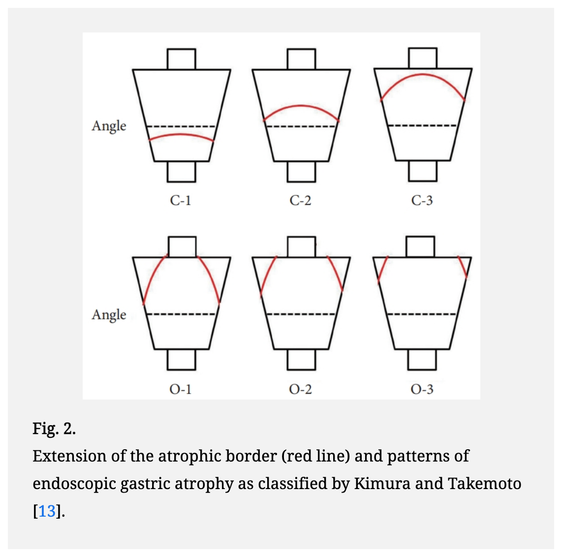 대한소화기내시경학회 학술지 Clinical Endoscopy 2019년 리뷰 Figure 2 — 위축 경계(붉은 선)가 C-1부터 O-3까지 올라가는 양상을 그린 기무라-다케모토 분류 도식