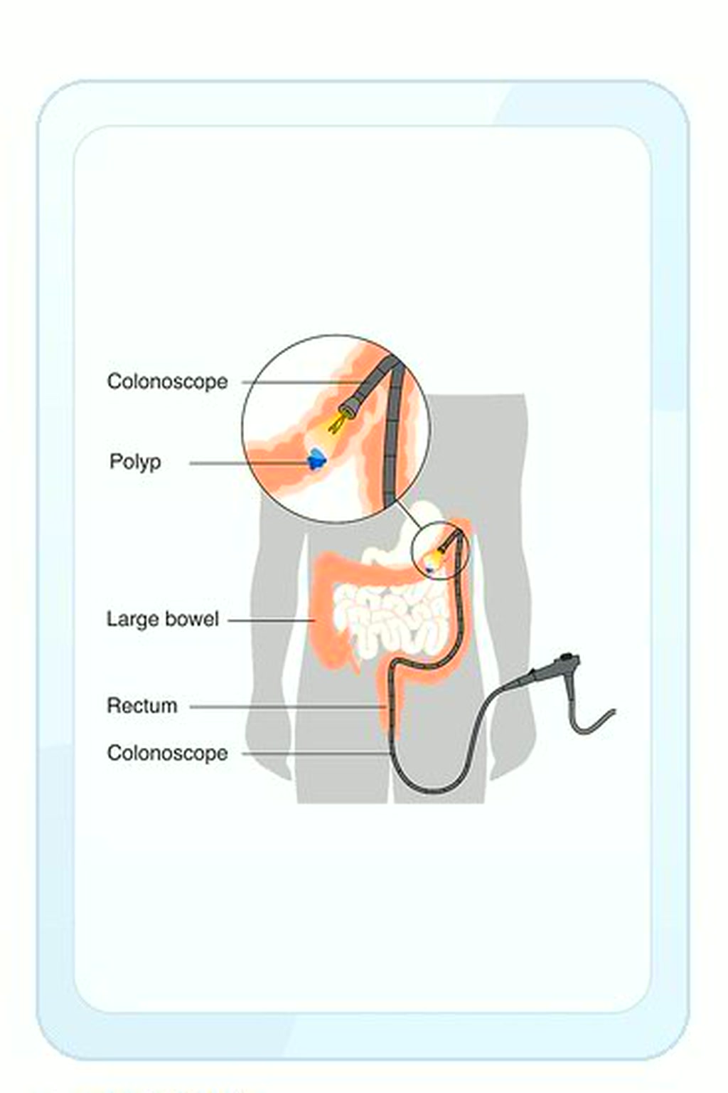 대장 용종절제술 모식도